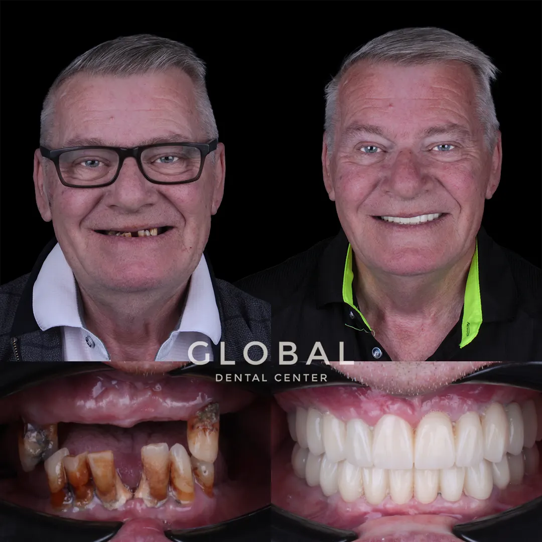 Dental Implants before and after result
