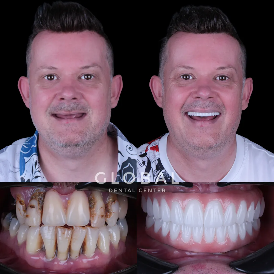 Dental Implants before and after result