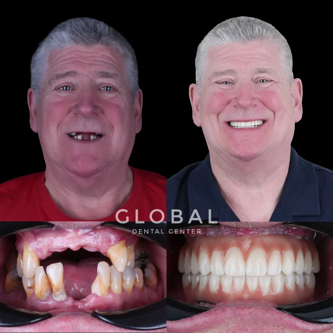 Dental Implants before and after result