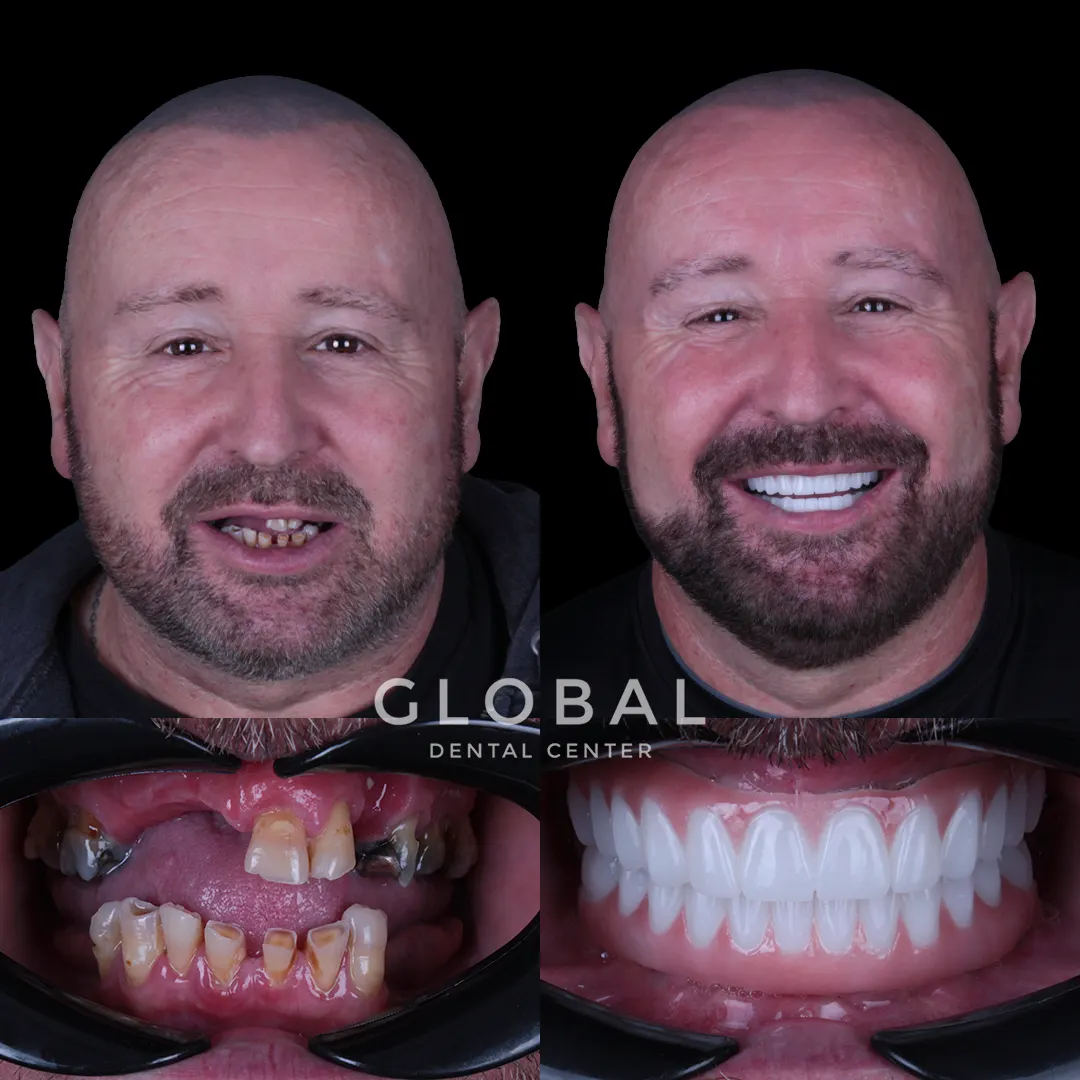Dental Implants before and after result