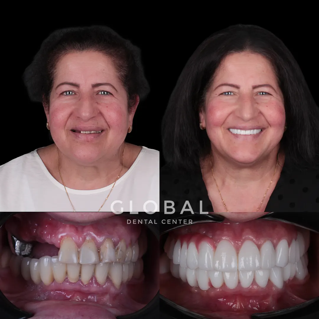 Dental Implants before and after result