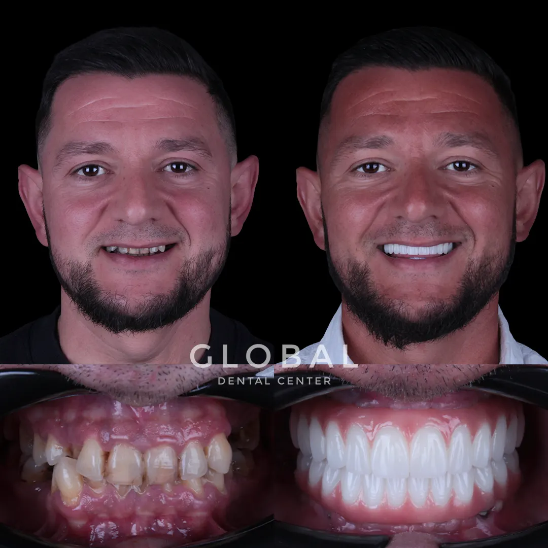 Dental Implants before and after result