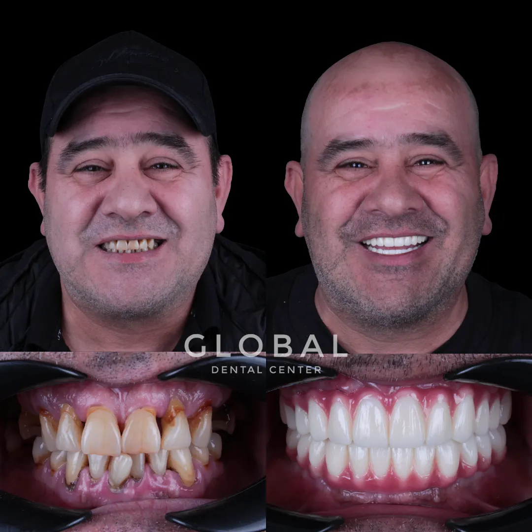 Dental Implants before and after result
