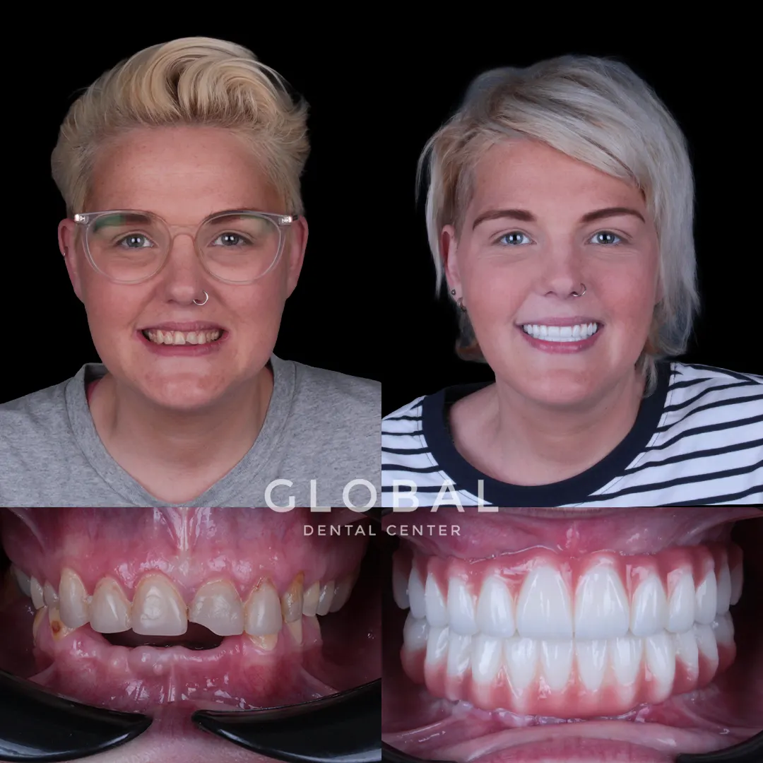 Dental Implants before and after result