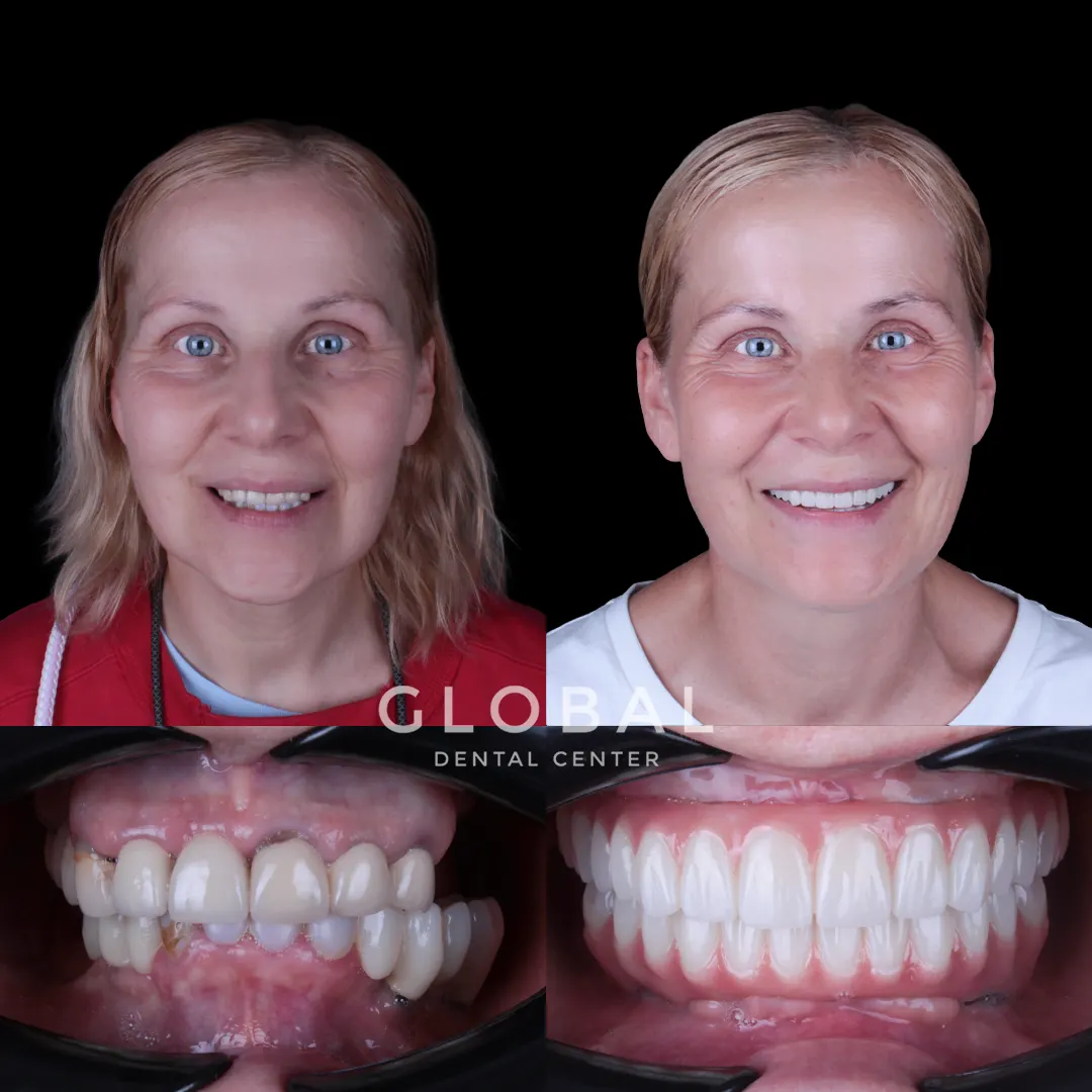 Dental Implants before and after result