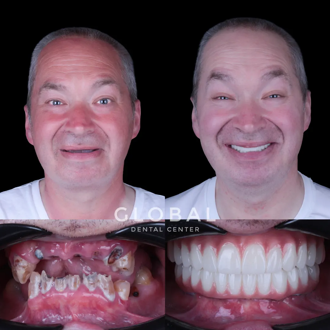 Dental Implants before and after result
