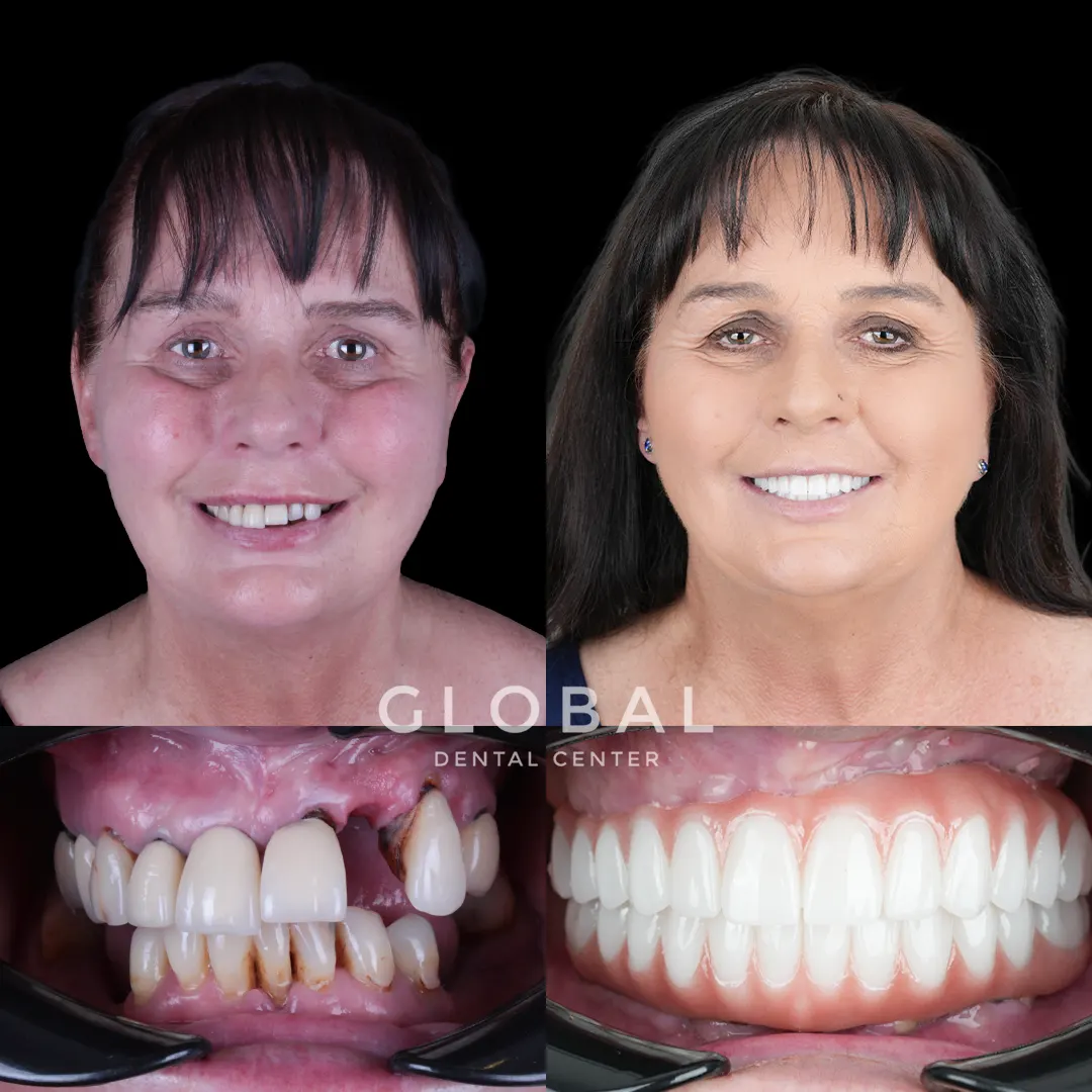 Dental Implants before and after result