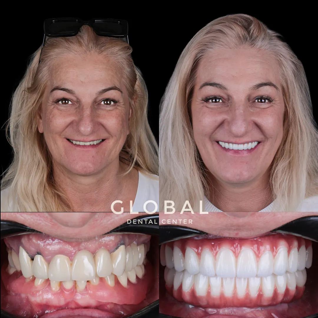 Dental Implants before and after result
