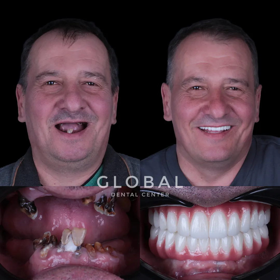 Dental Implants before and after result