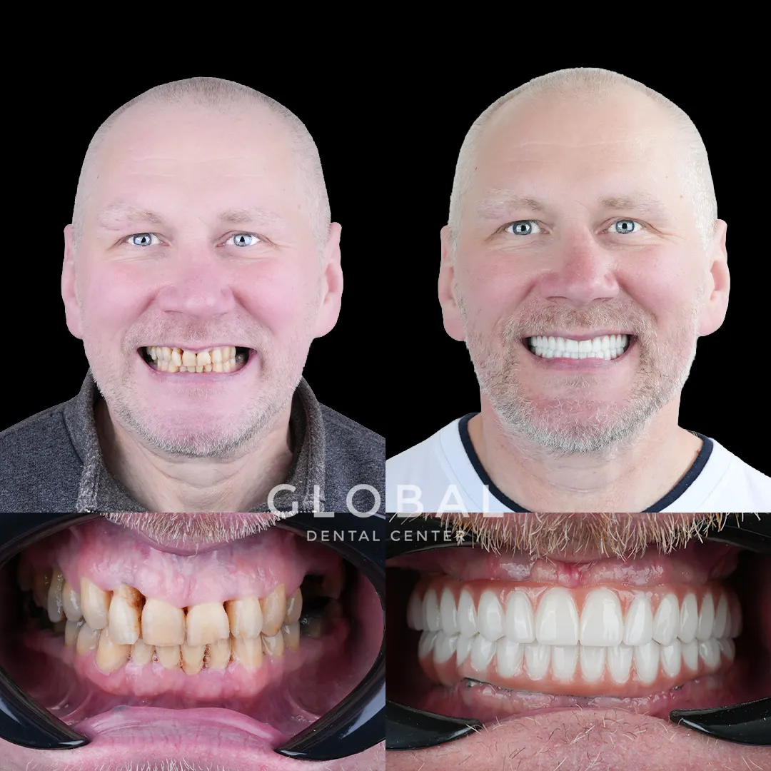 Dental Implants before and after result