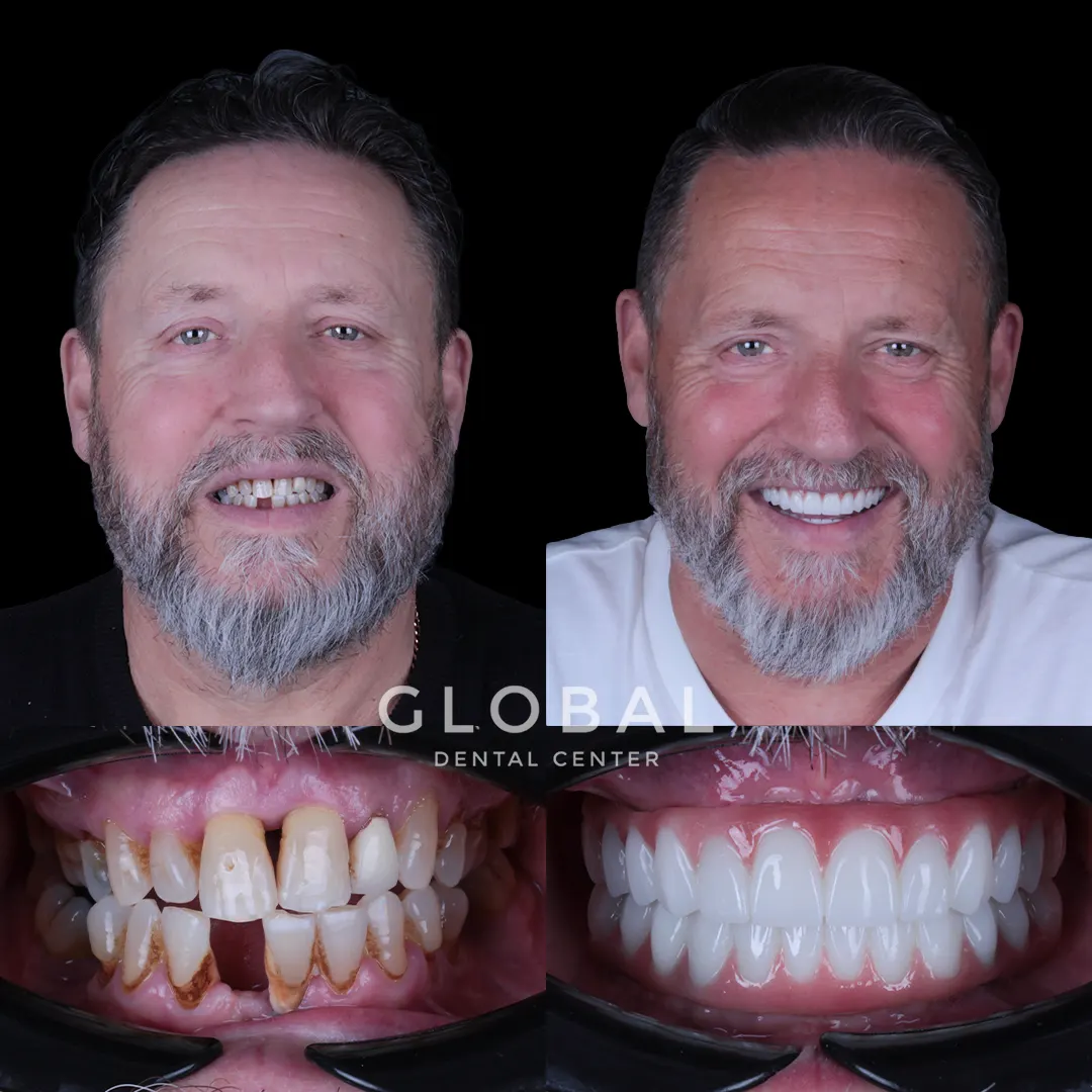 Dental Implants before and after result