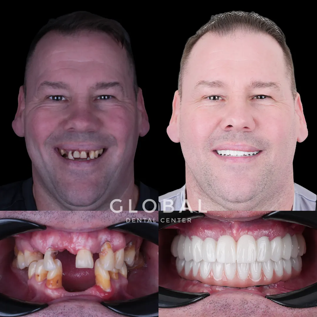 Dental Implants before and after result