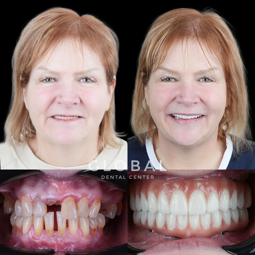 Dental Implants before and after result
