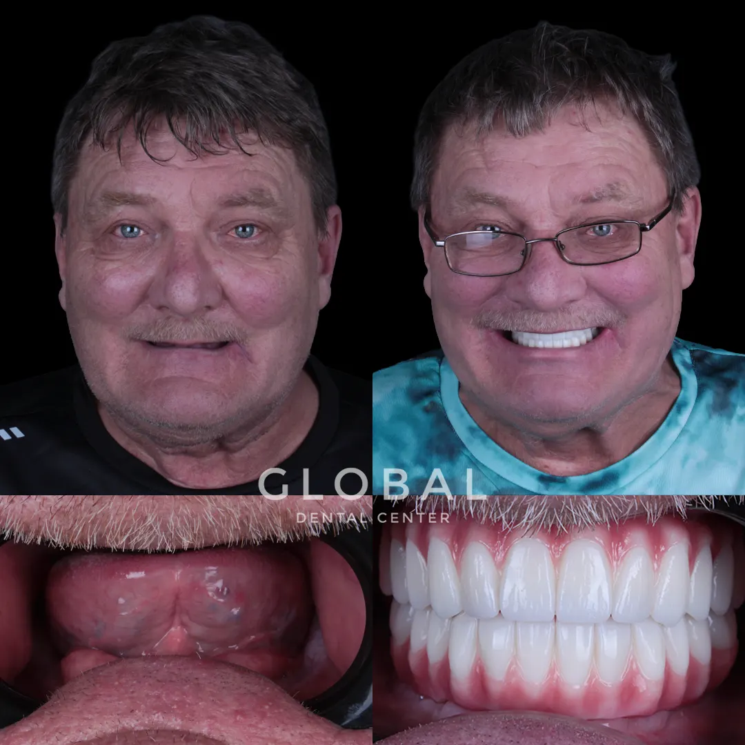 Dental Implants before and after result