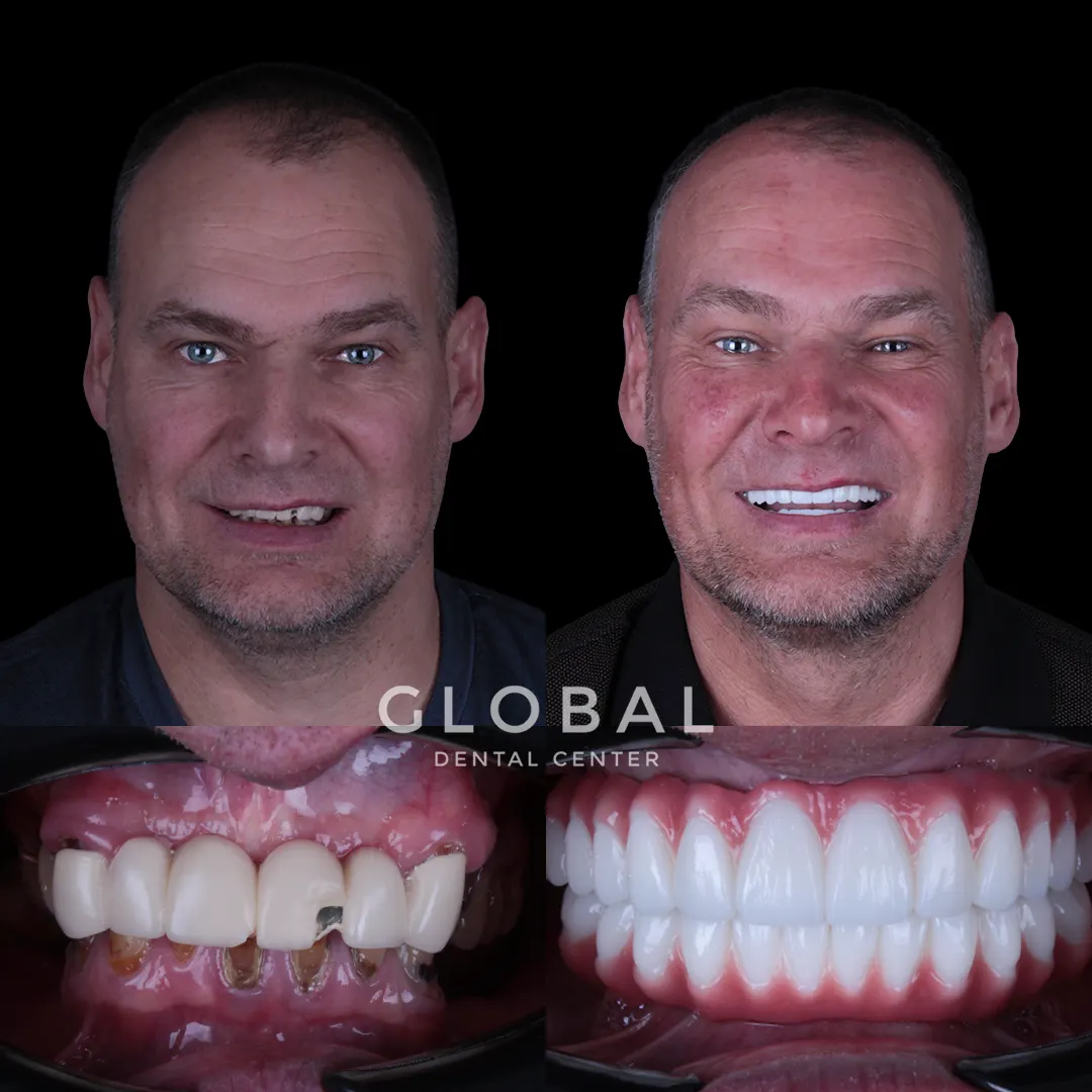 Dental Implants before and after result