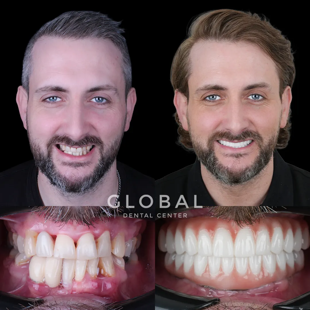 Dental Implants before and after result