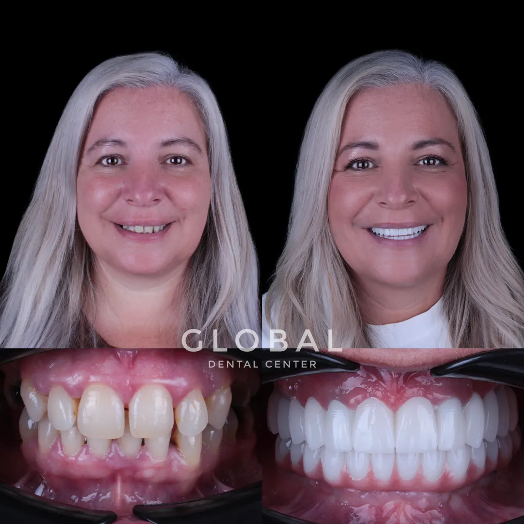 Dental Implants before and after result