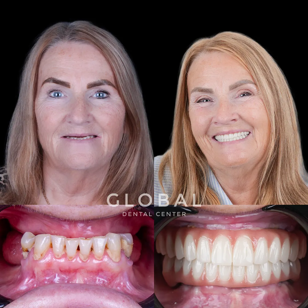 Dental Implants before and after result