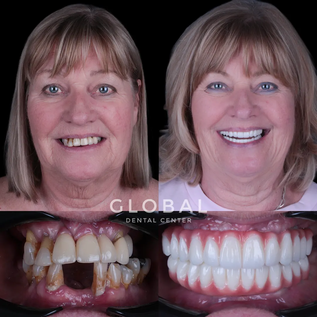 Dental Implants before and after result