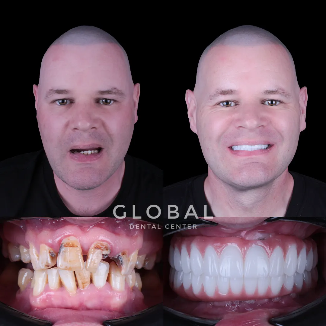 Dental Implants before and after result
