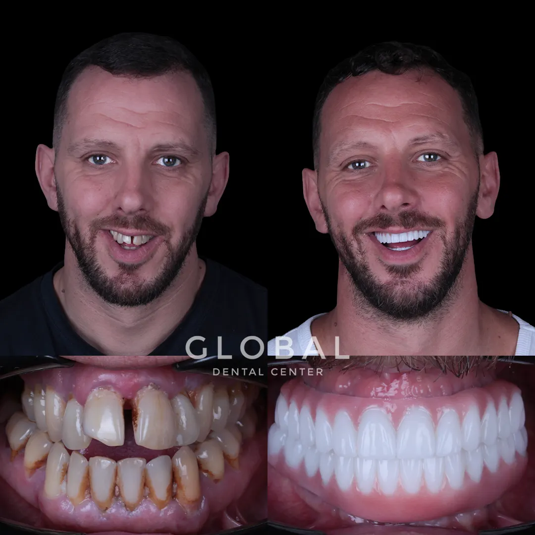 Dental Implants before and after result