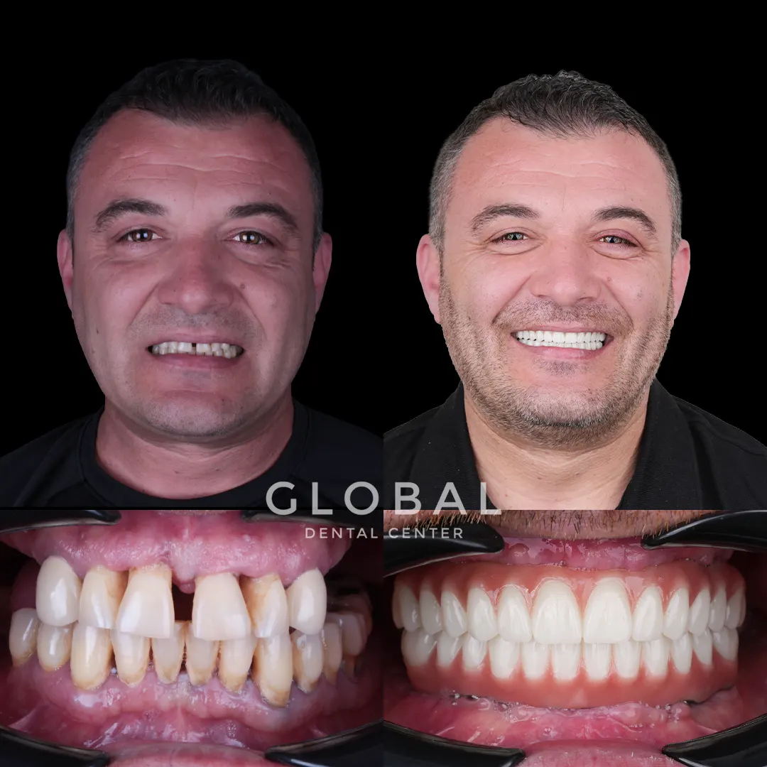 Dental Implants before and after result