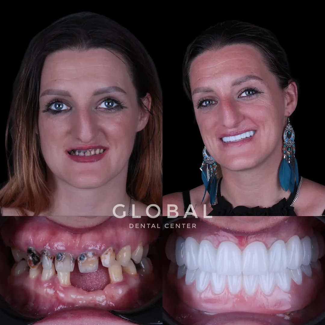 Dental Implants before and after result