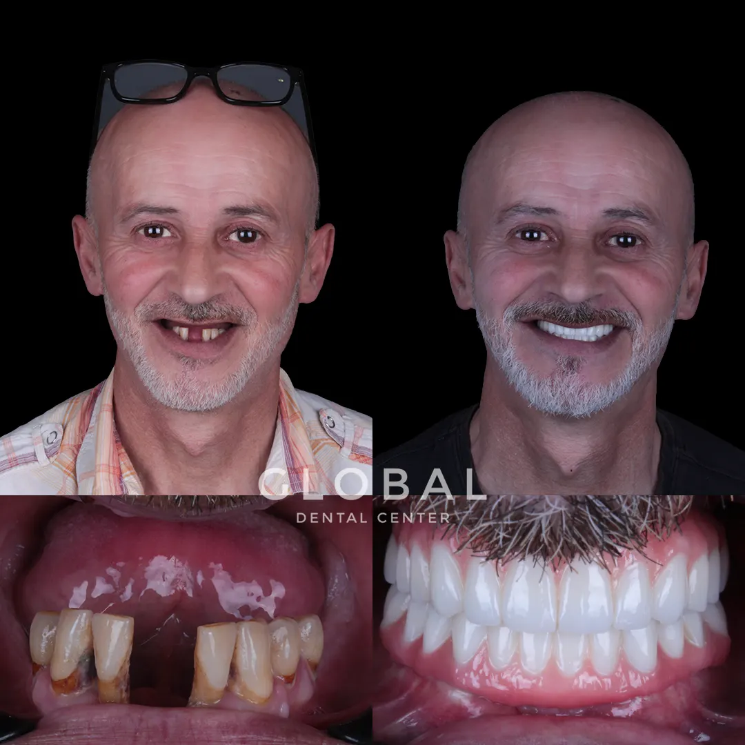 Dental Implants before and after result