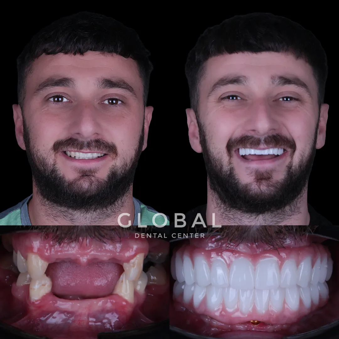 Dental Implants before and after result