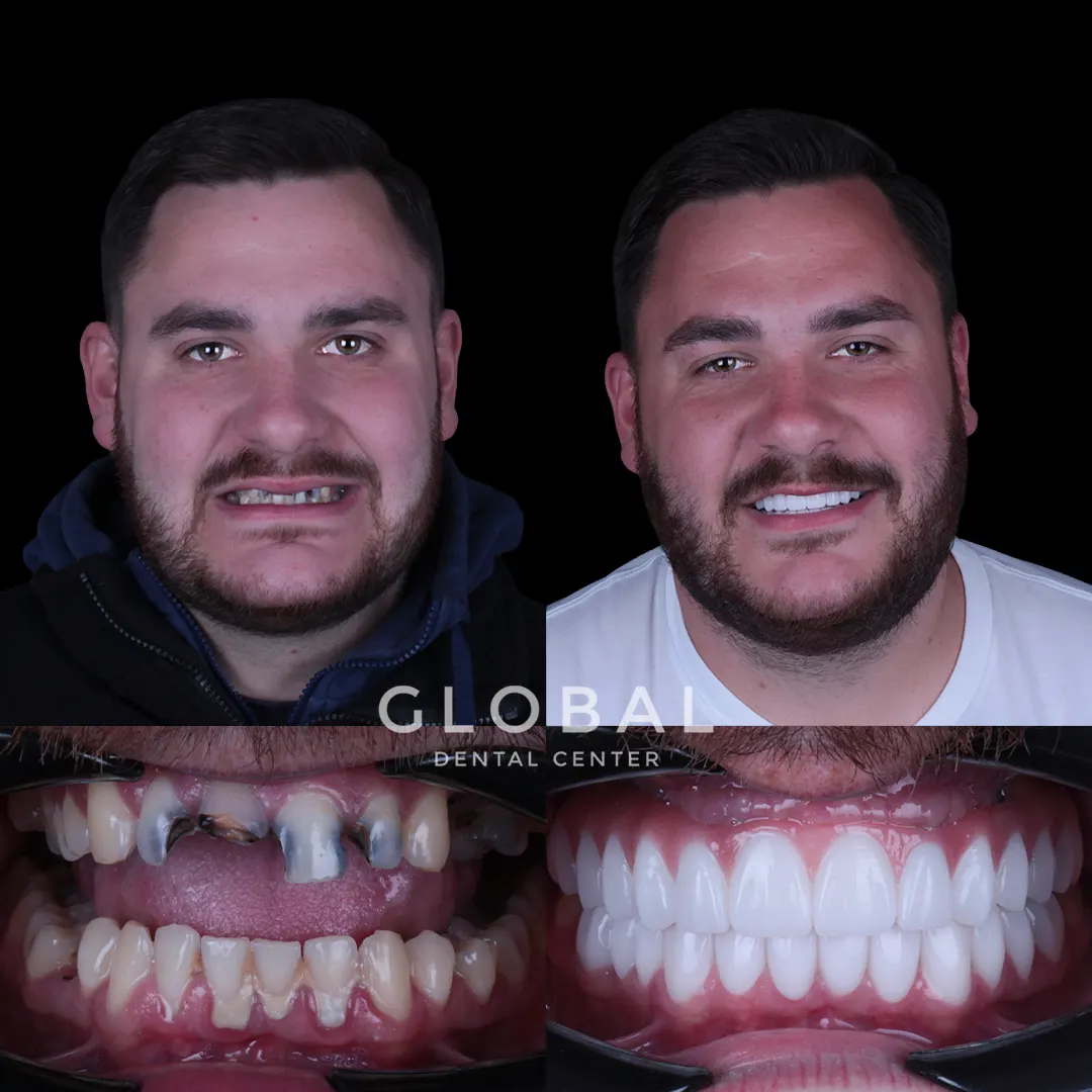 Dental Implants before and after result