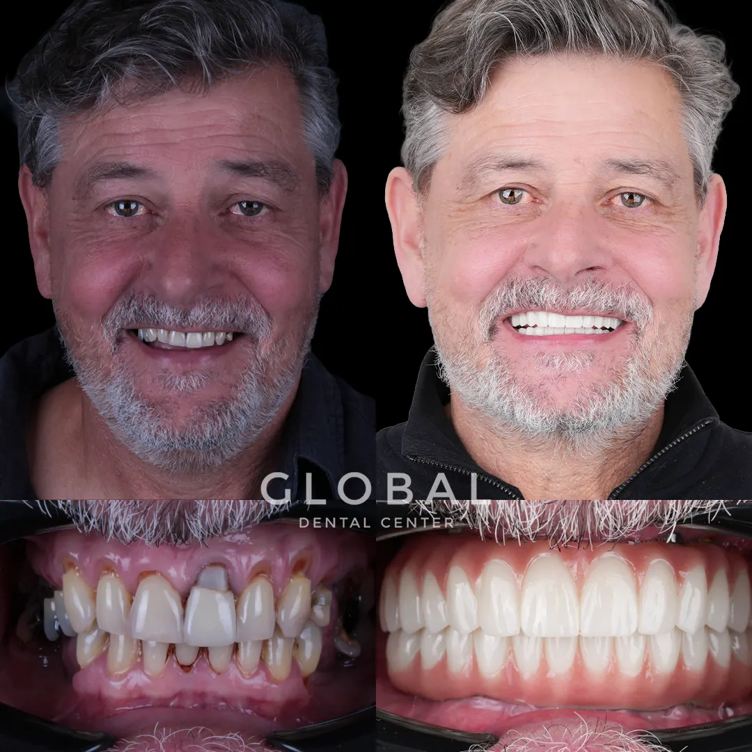 Dental Implants before and after result