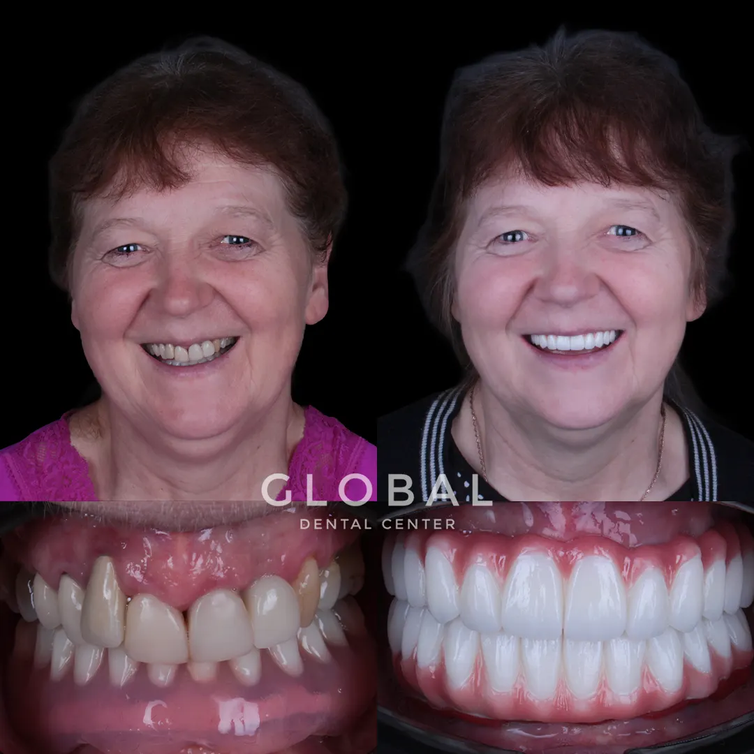 Dental Implants before and after result