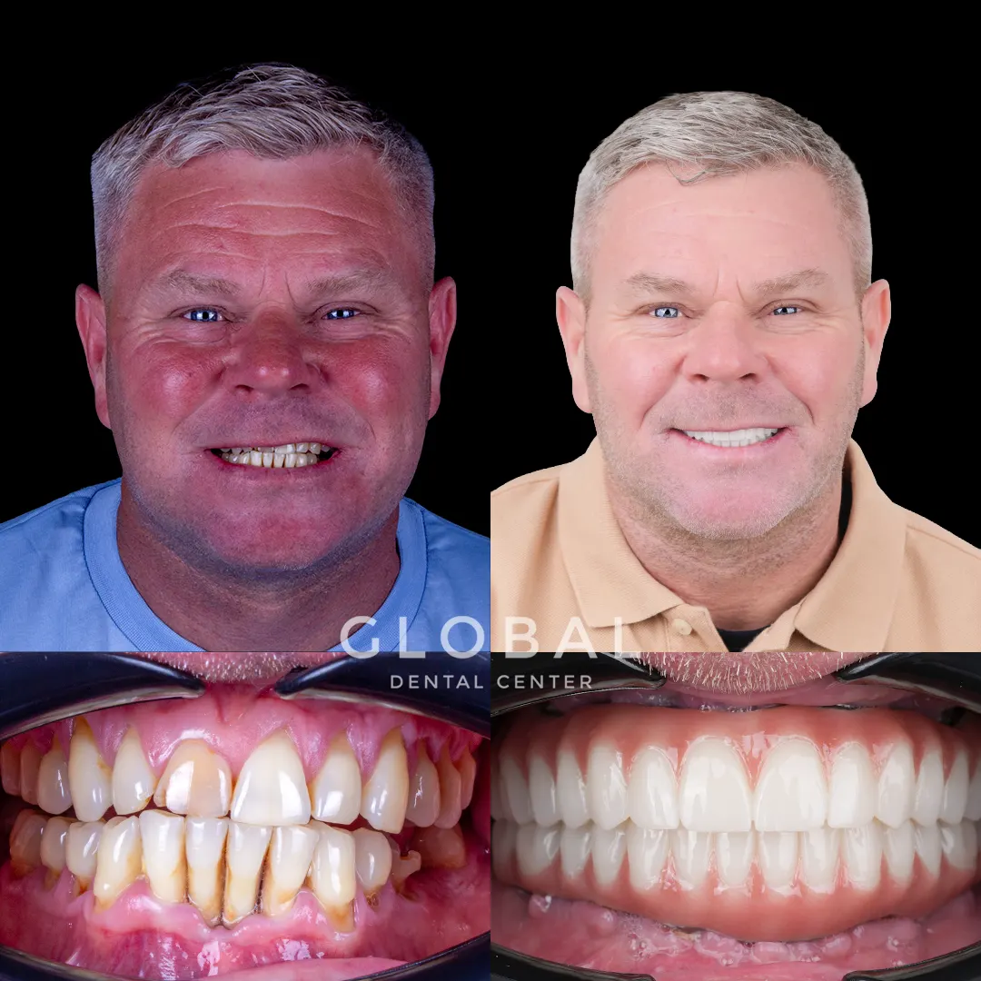 Dental Implants before and after result
