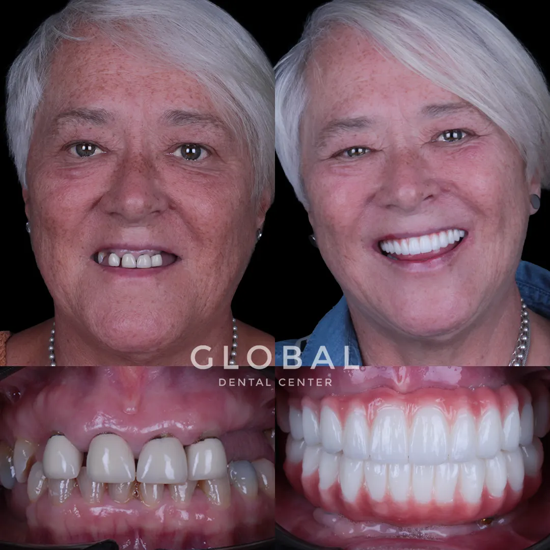 Dental Implants before and after result