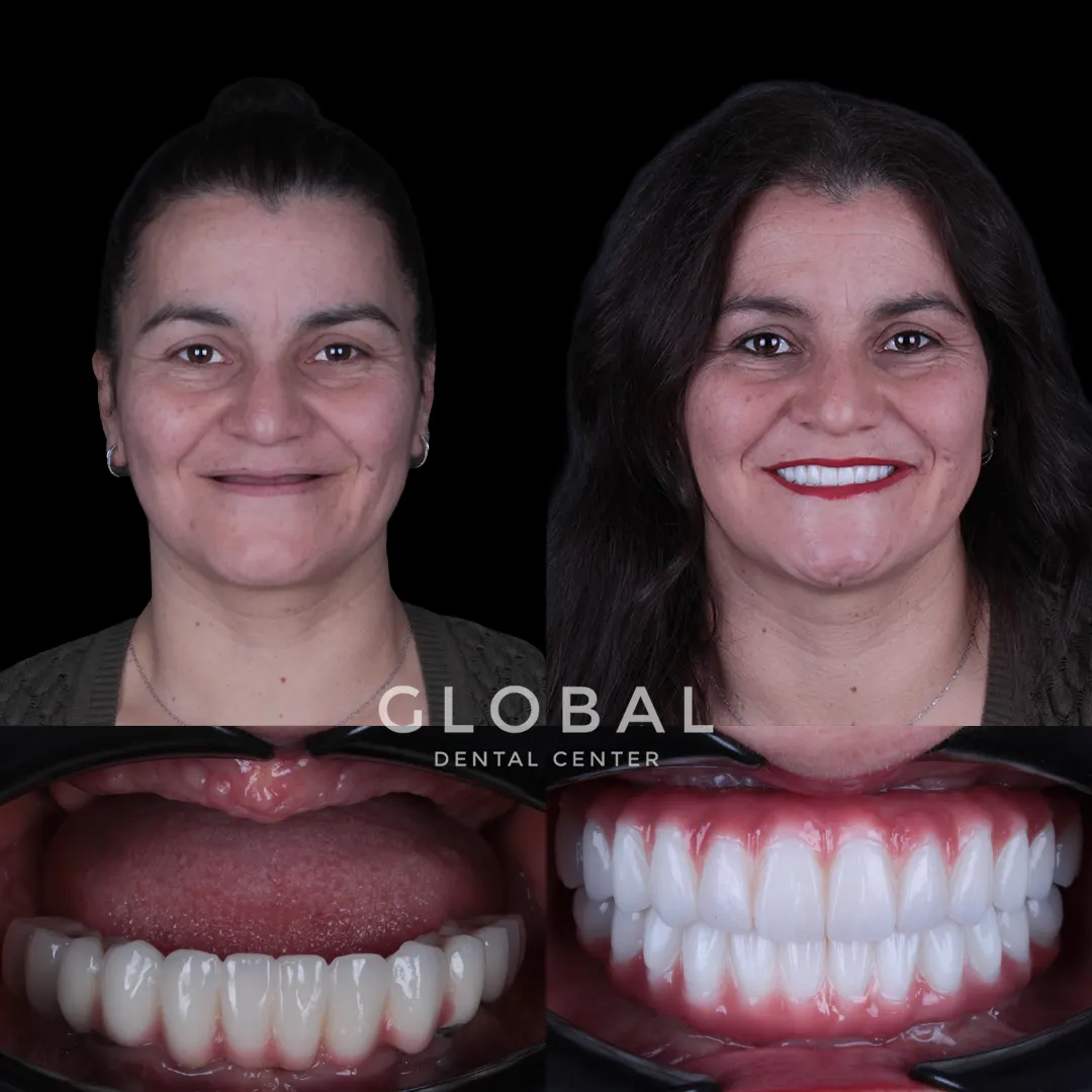 Dental Implants before and after result