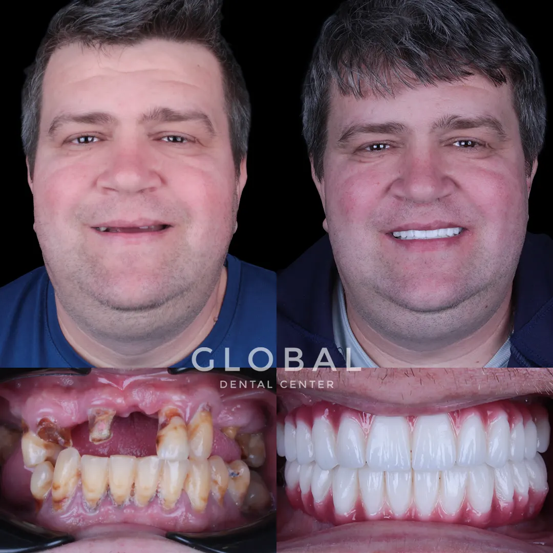 Dental Implants before and after result