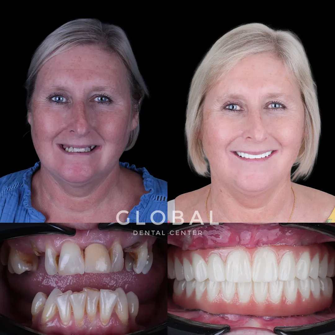 Dental Implants before and after result