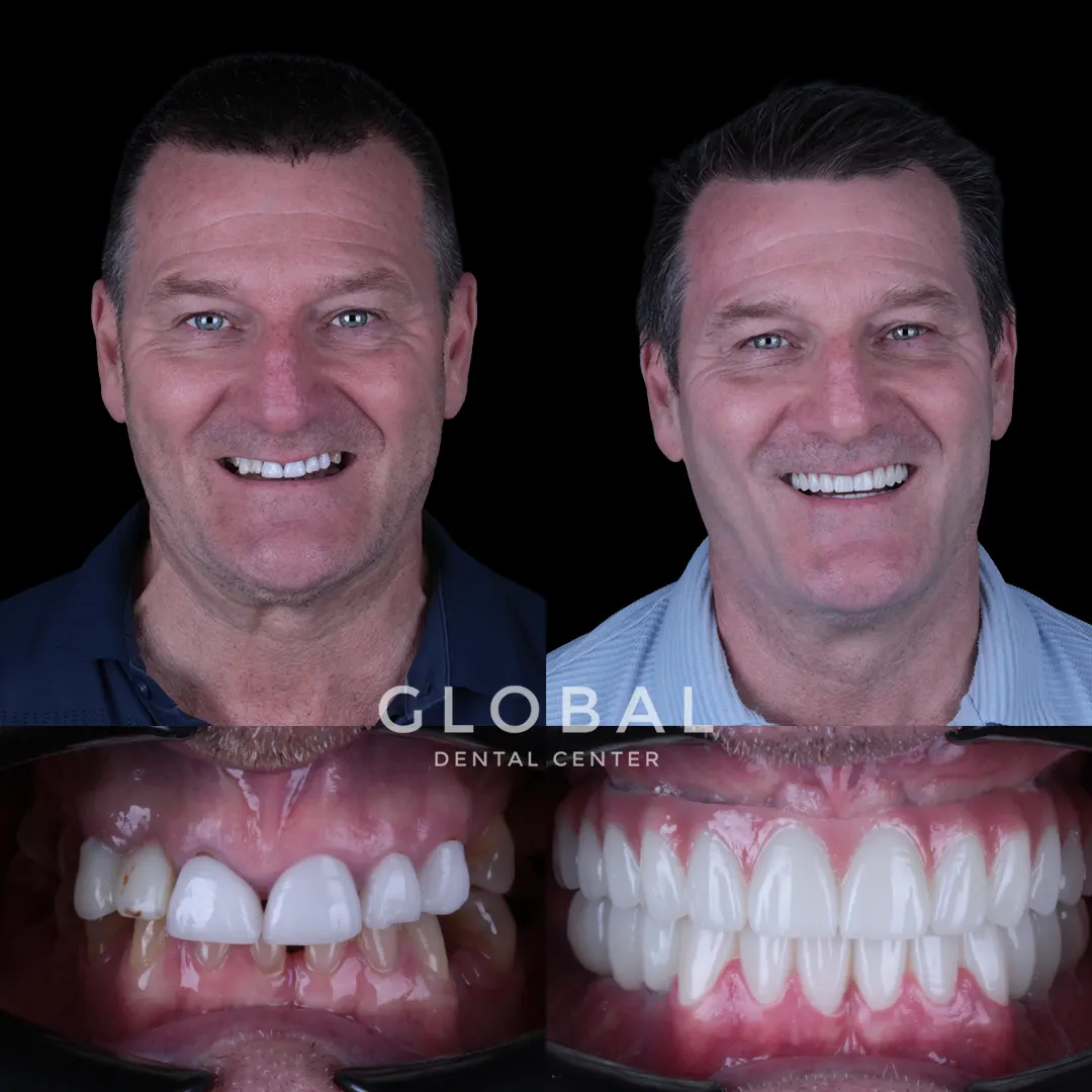 Dental Implants before and after result