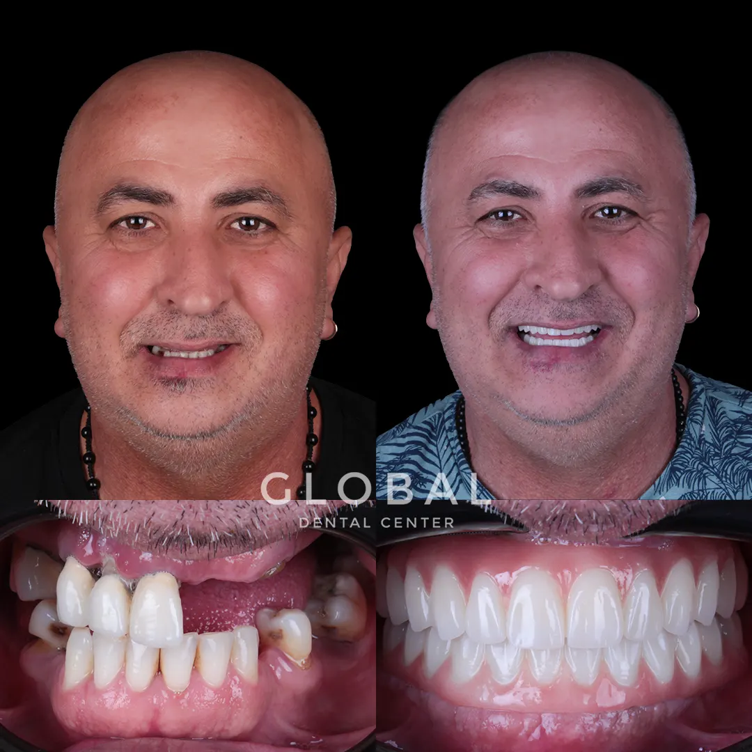Dental Implants before and after result