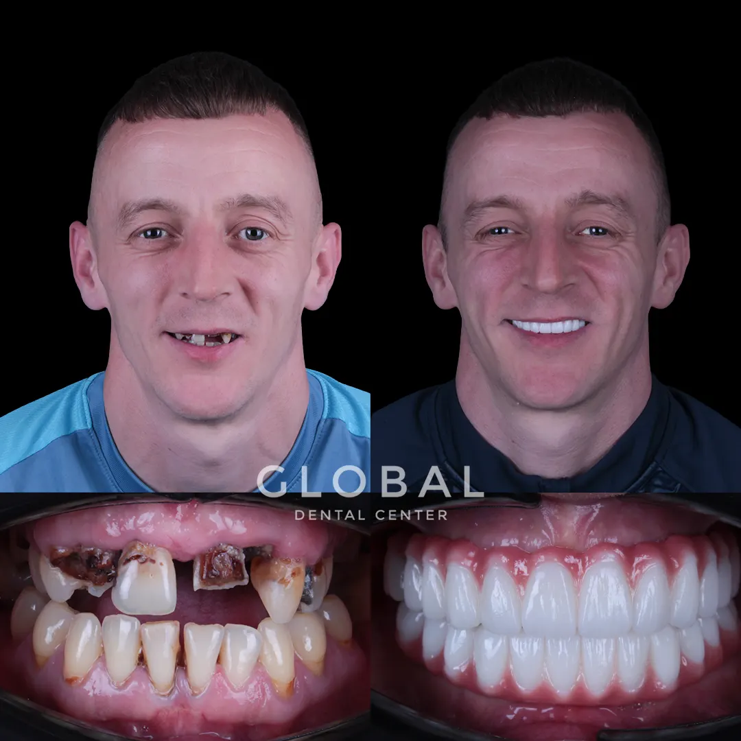 Dental Implants before and after result