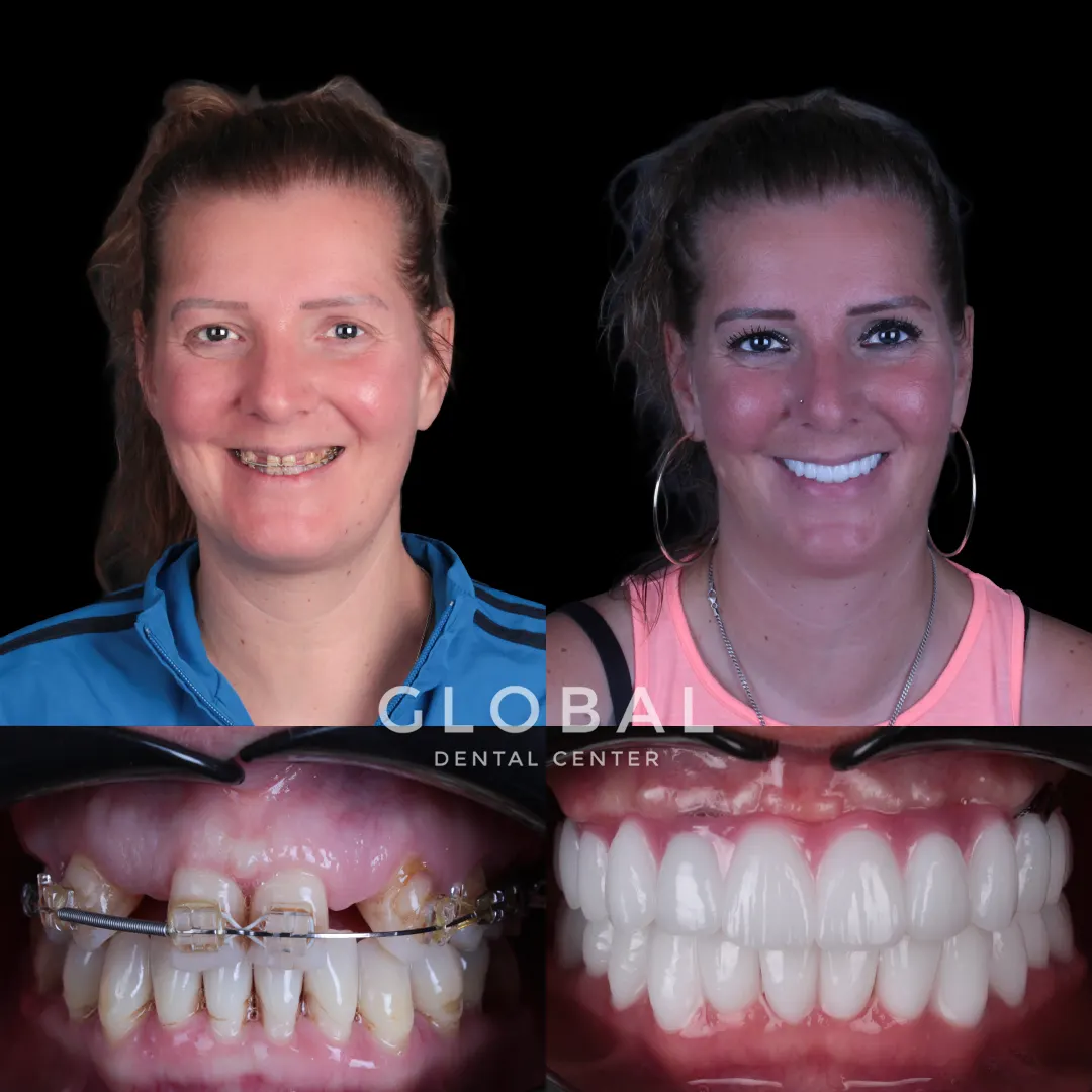Dental Implants before and after result