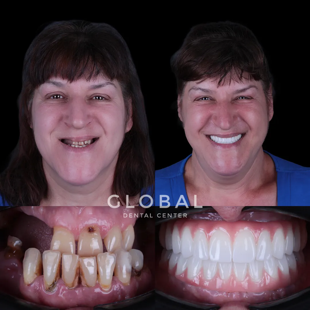 Dental Implants before and after result
