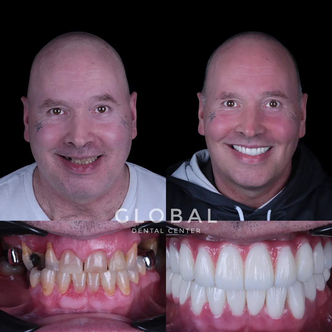 Dental Implants before and after result