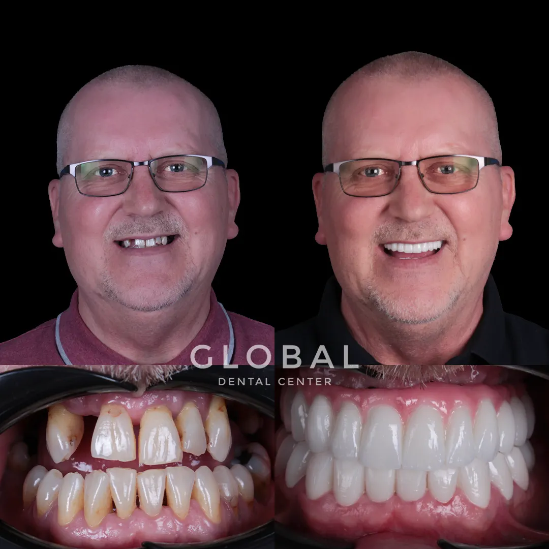 Dental Implants before and after result
