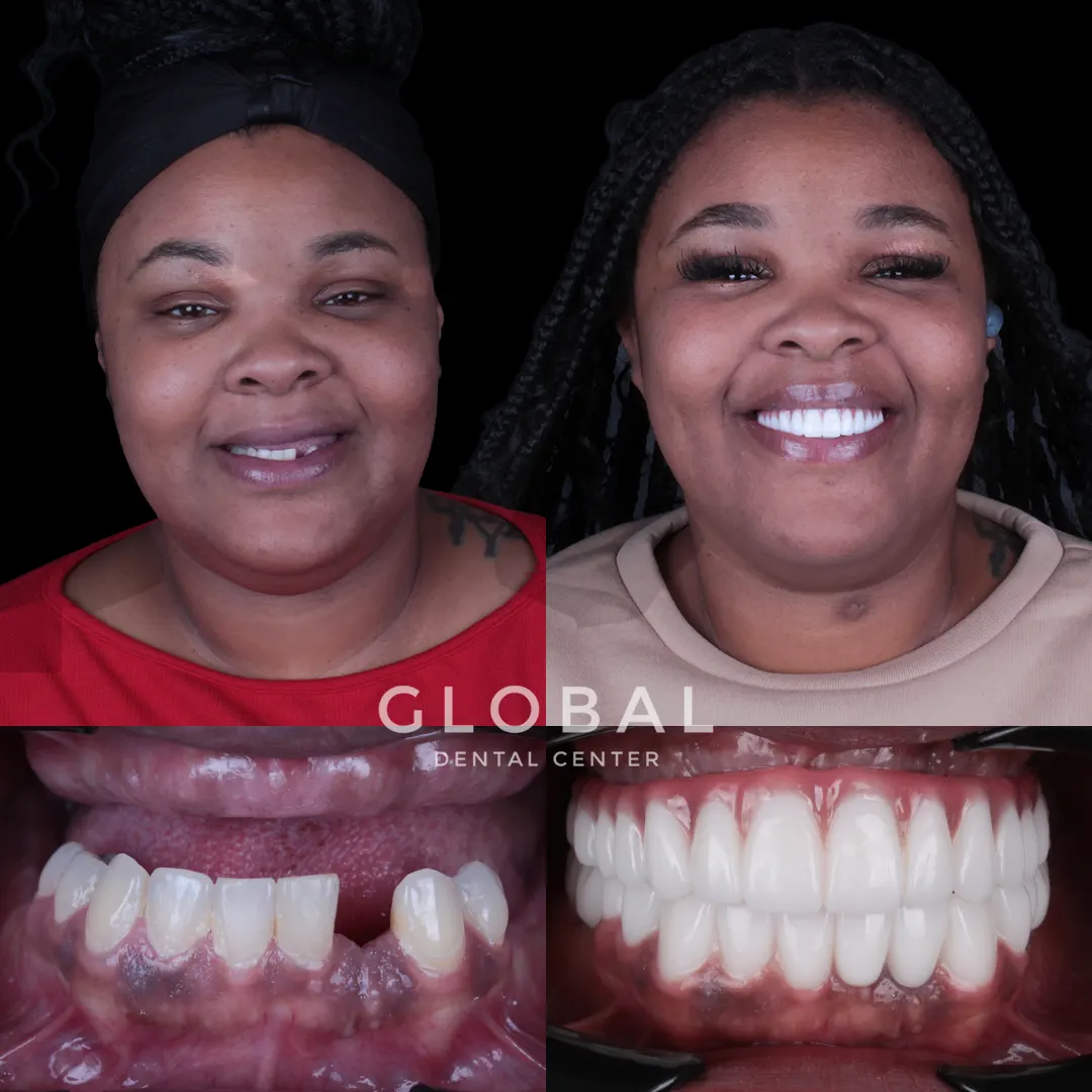 Dental Implants before and after result