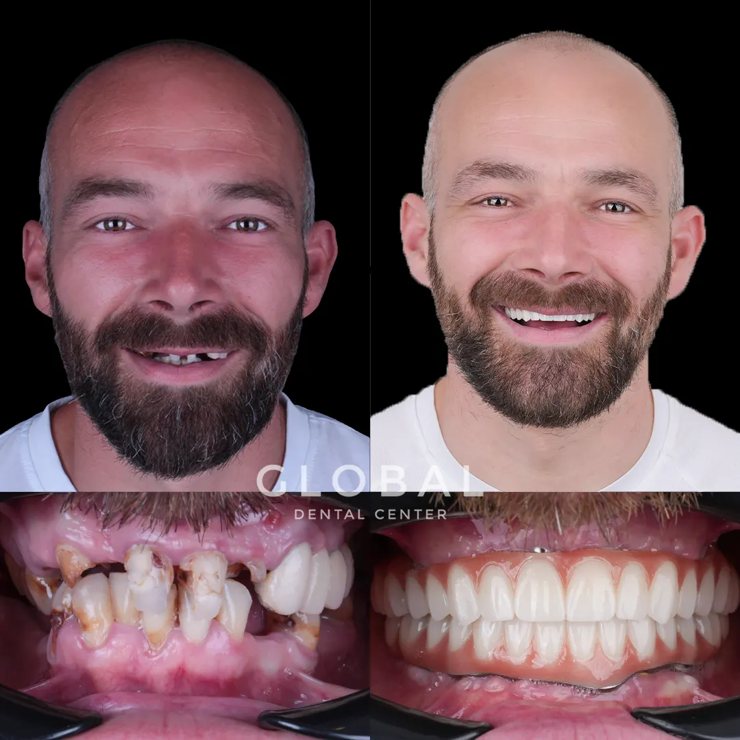 Dental Implants before and after result