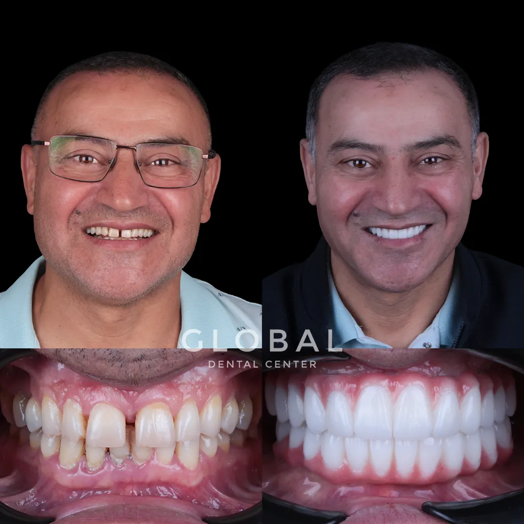 Dental Implants before and after result