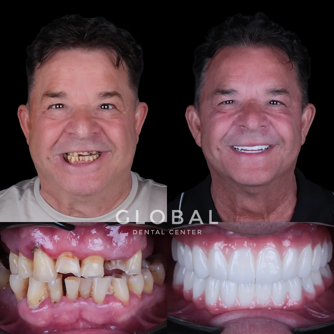 Dental Implants before and after result