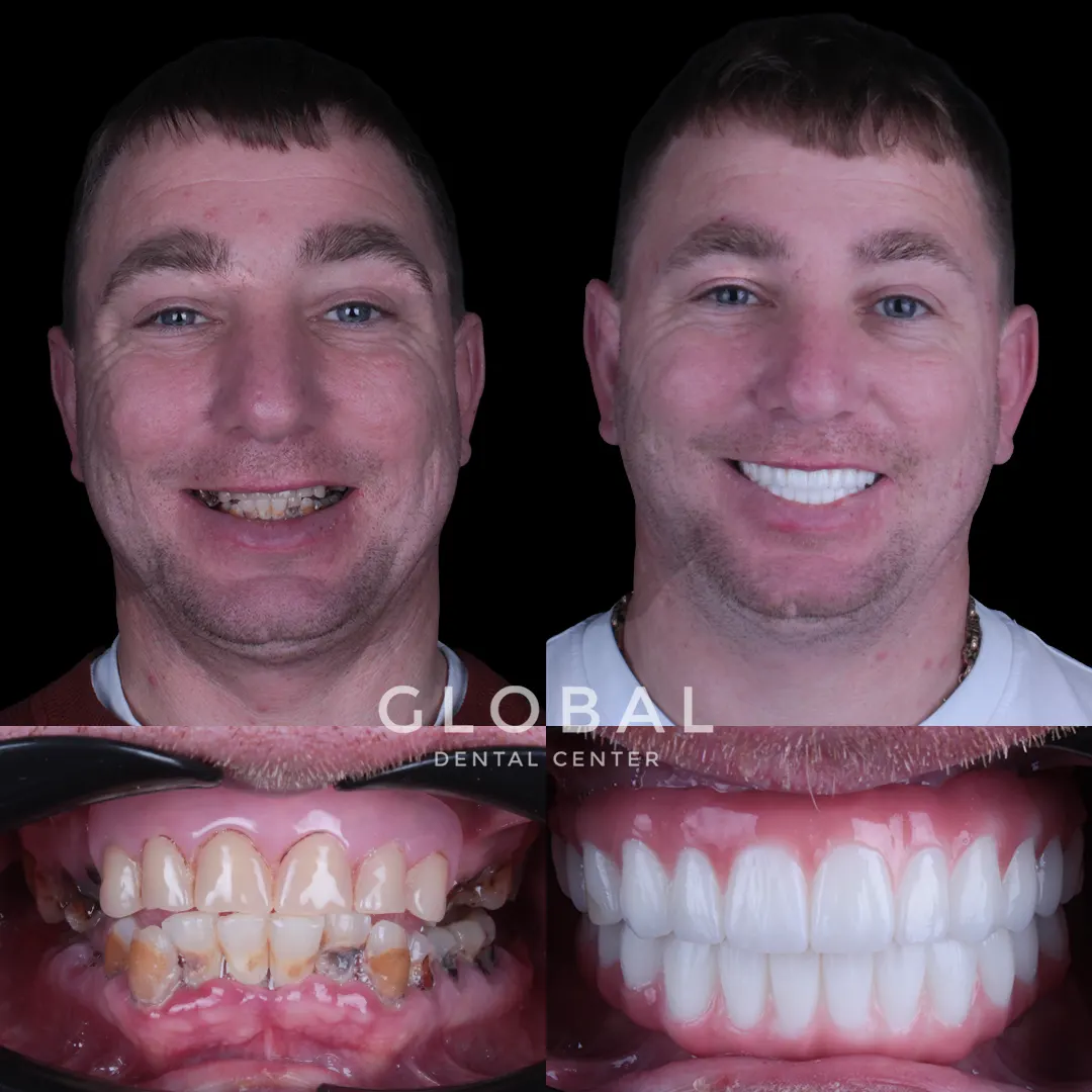 Dental Implants before and after result