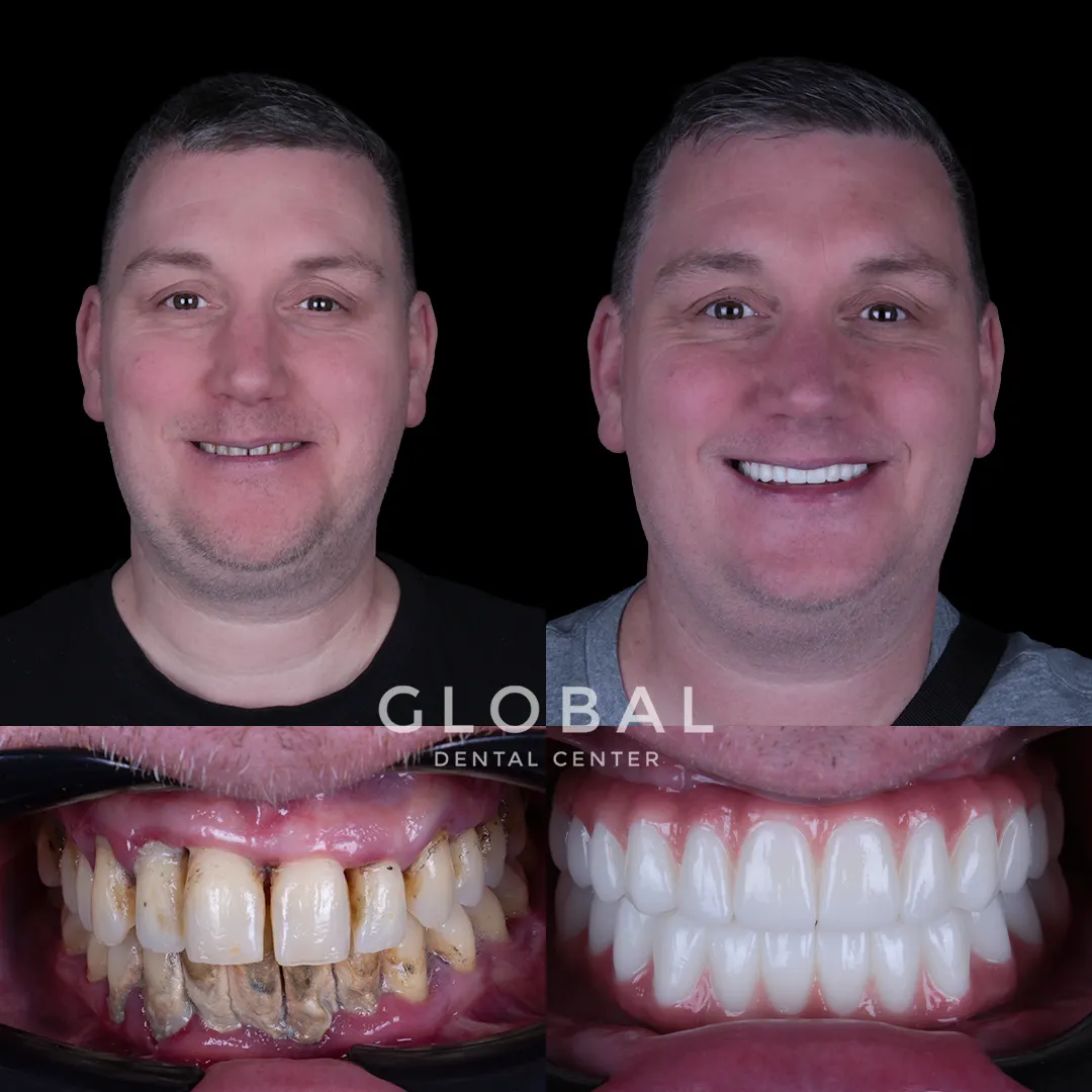 Dental Implants before and after result